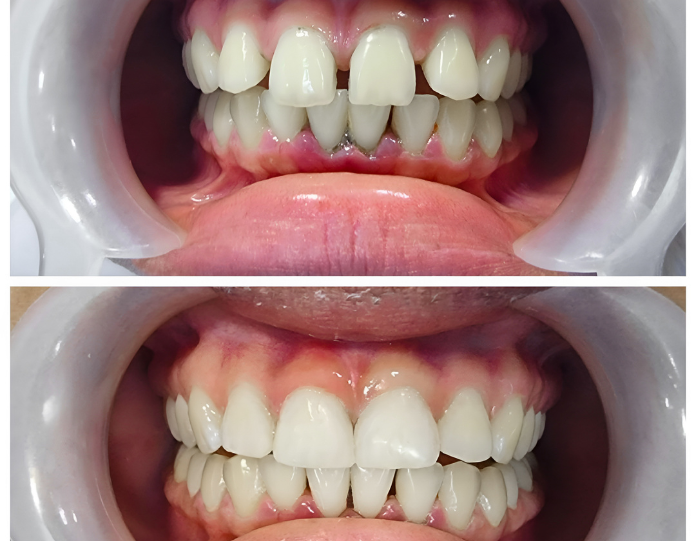 before and after dental bonding treatment